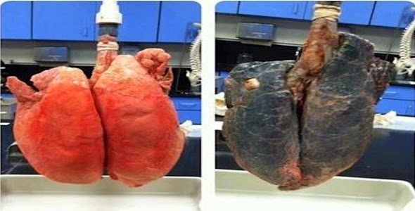 A diferença real entre o pulmão de um fumante e de um não fumante